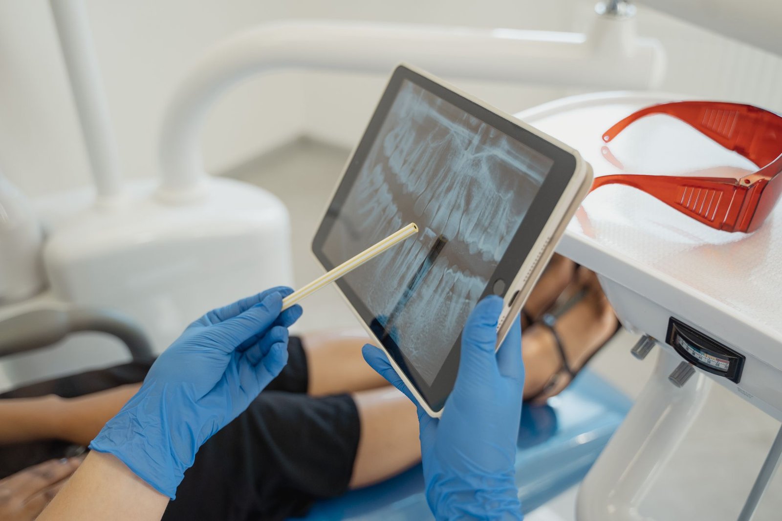 Endodoncia Compleja