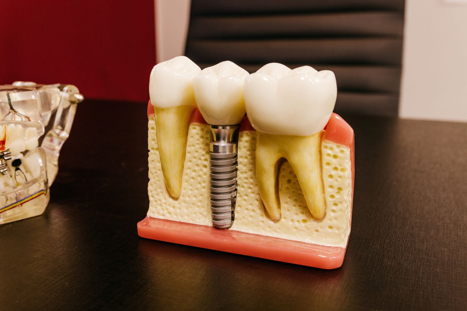 Prótesis sobre Implantes